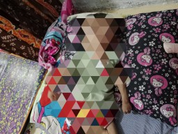 Kondisi Askyla Furi Aziza, balita berusia 1 tahun 7 bulan penderita hidrosefalus (Memanggil.co/lst)