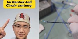 Sering Dengar Istilah Ring Jantung? Ternyata Begini Penampakannya. (Instagram/dr.bobbyjantung)
