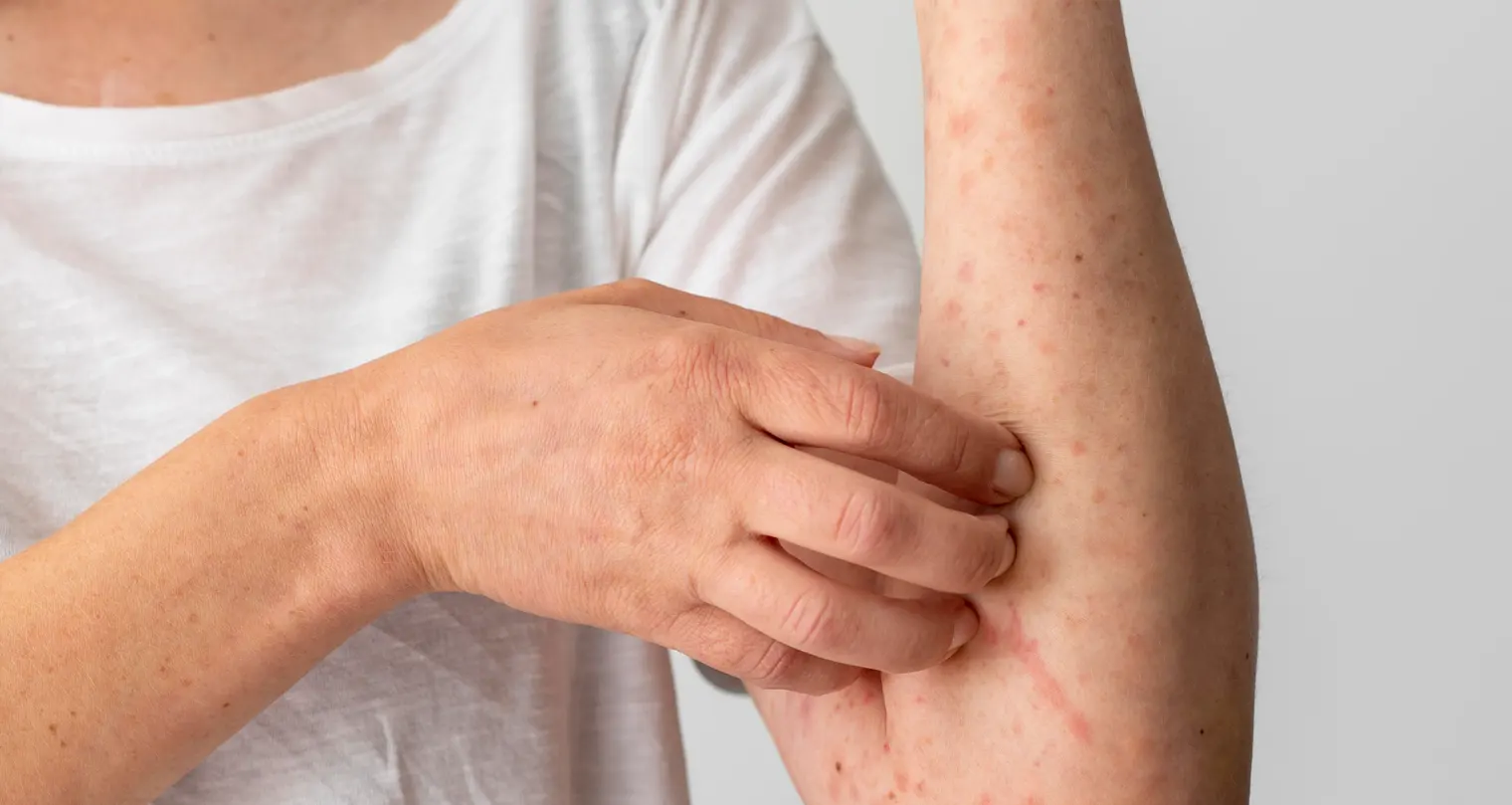 RSUD Cepu Ungkap Gejala Mpox dan Langkah Pencegahan yang Harus Diketahui